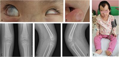 Case Report: Corneal Leucoma as a Novel Clinical Presentation of Nail-Patella Syndrome in a 5-Year-Old Girl